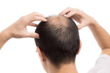最新研究发现致秃关键 未来有望找出有效的防秃头治疗方法
